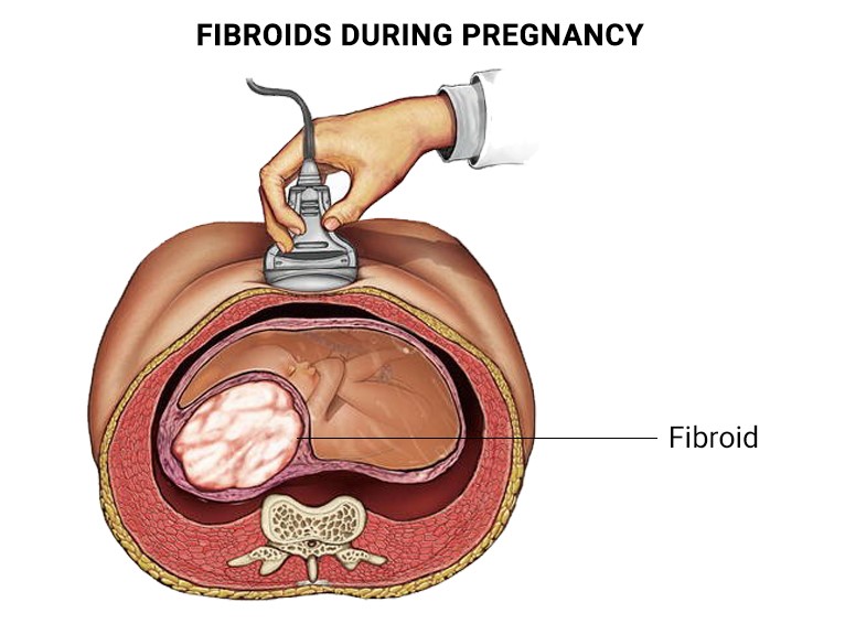 Ινομυώματα μήτρας και Εγκυμοσύνη