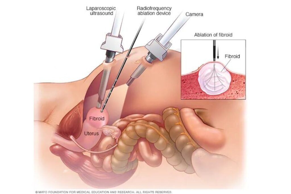 Λαπαροσκοπική αφαίρεση ινομυωμάτων μήτρας