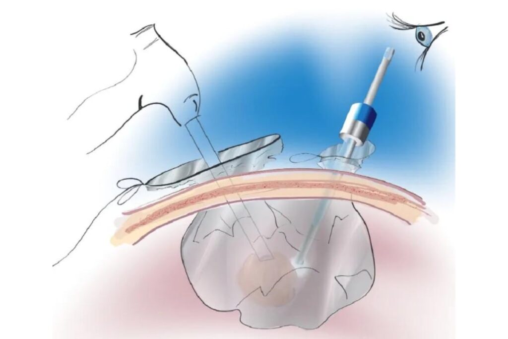 Ινομυώματα μήτρας αφαίρεση με ειδικό κλειστό σύστημα σάκου