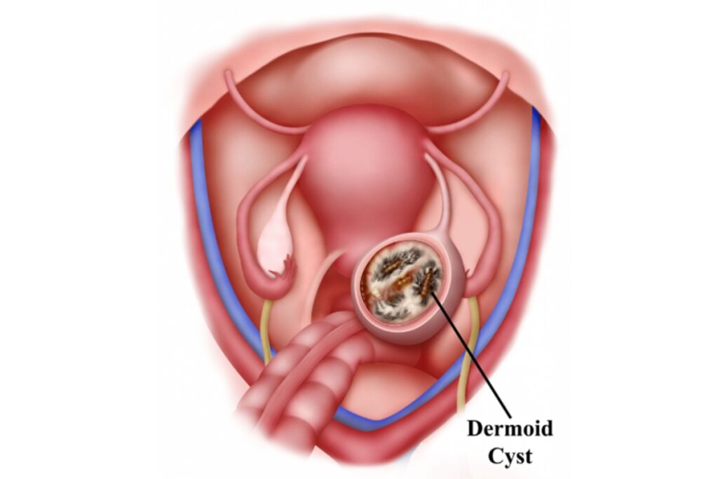 Δερμοειδής κύστη ωοθήκης