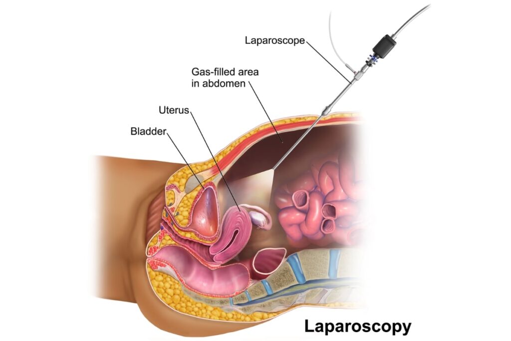 Λαπαροσκοπική Υστερεκτομή
