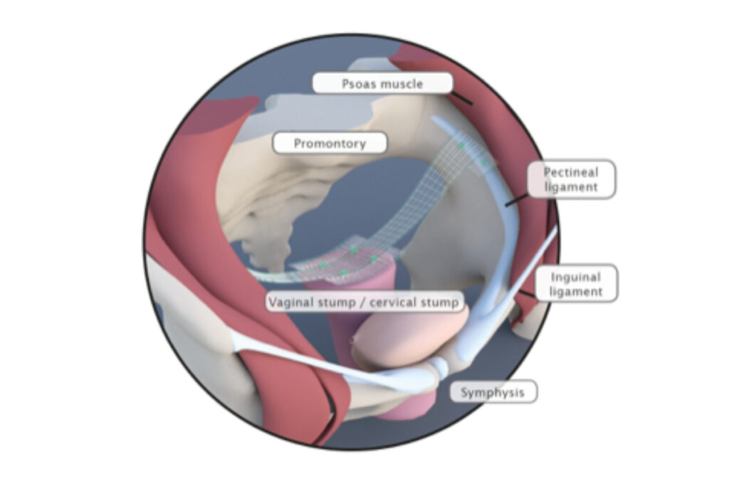 Σύγχρονη μέθοδος αντιμετώπισης πρόπτωσης μήτρας - Κτενοπηξία