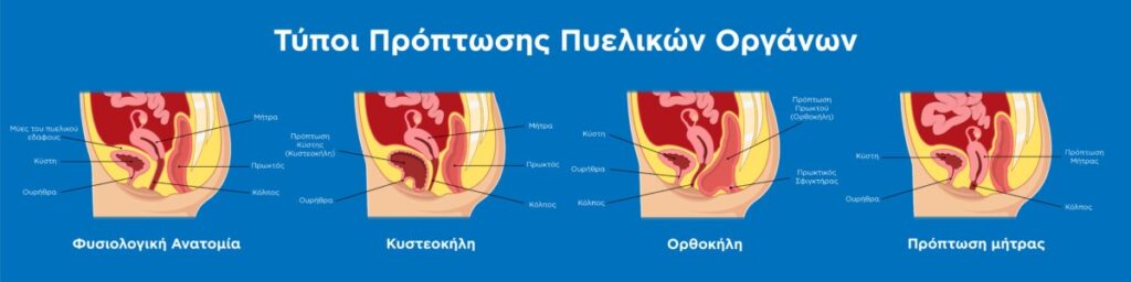 Τύποι πρόπτωσης πυελικών οργάνων