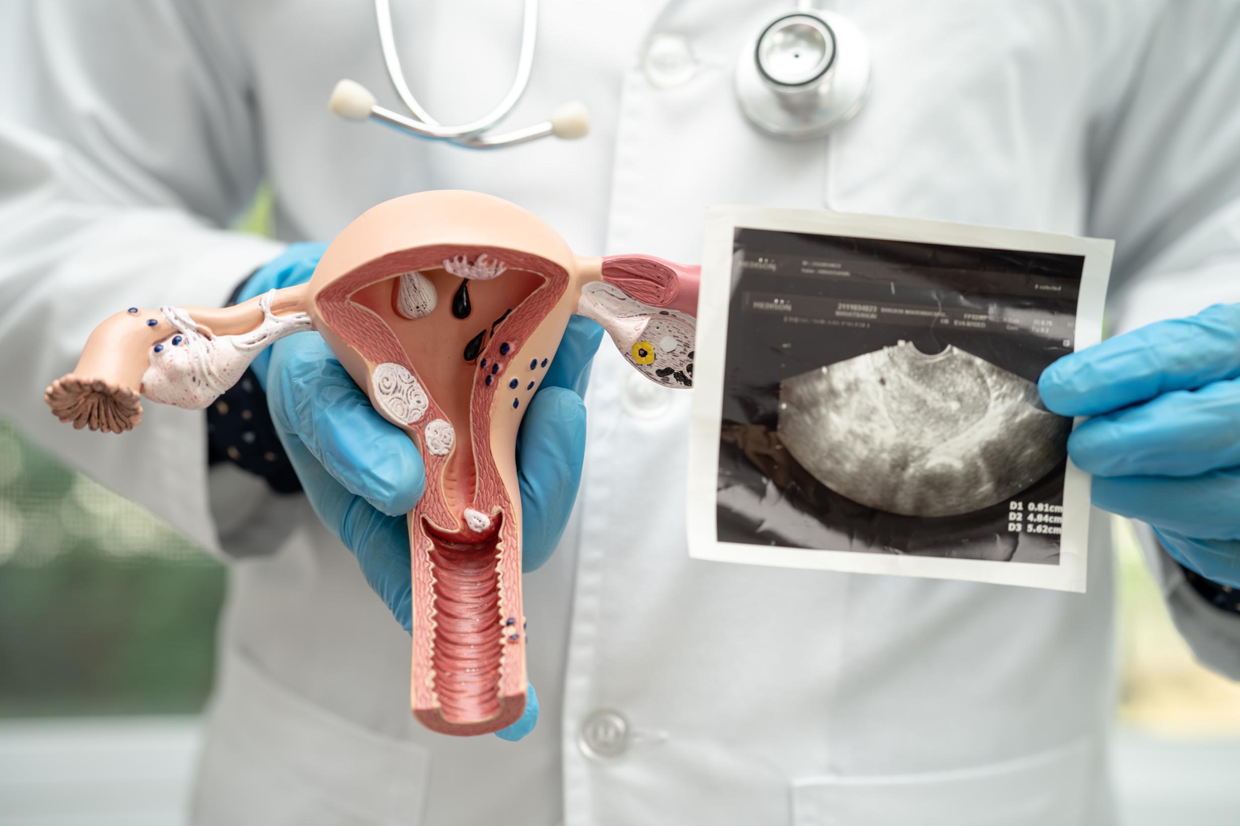 uterus and ovary doctor holding anatomy model and 2023 11 27 05 05 16 utc