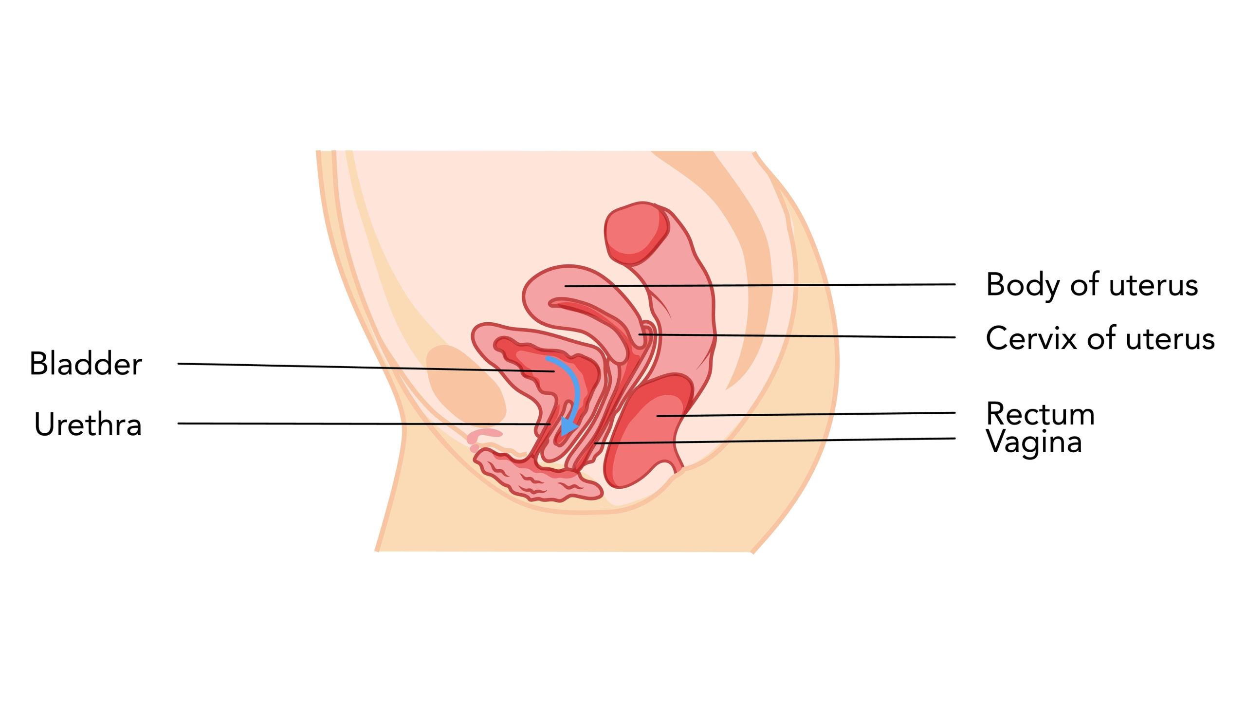 Laparoskopiki therapeia kysteokilis (1) Λαπαροσκοπική θεραπεία κυστεοκήλης χωρίς πλέγμα