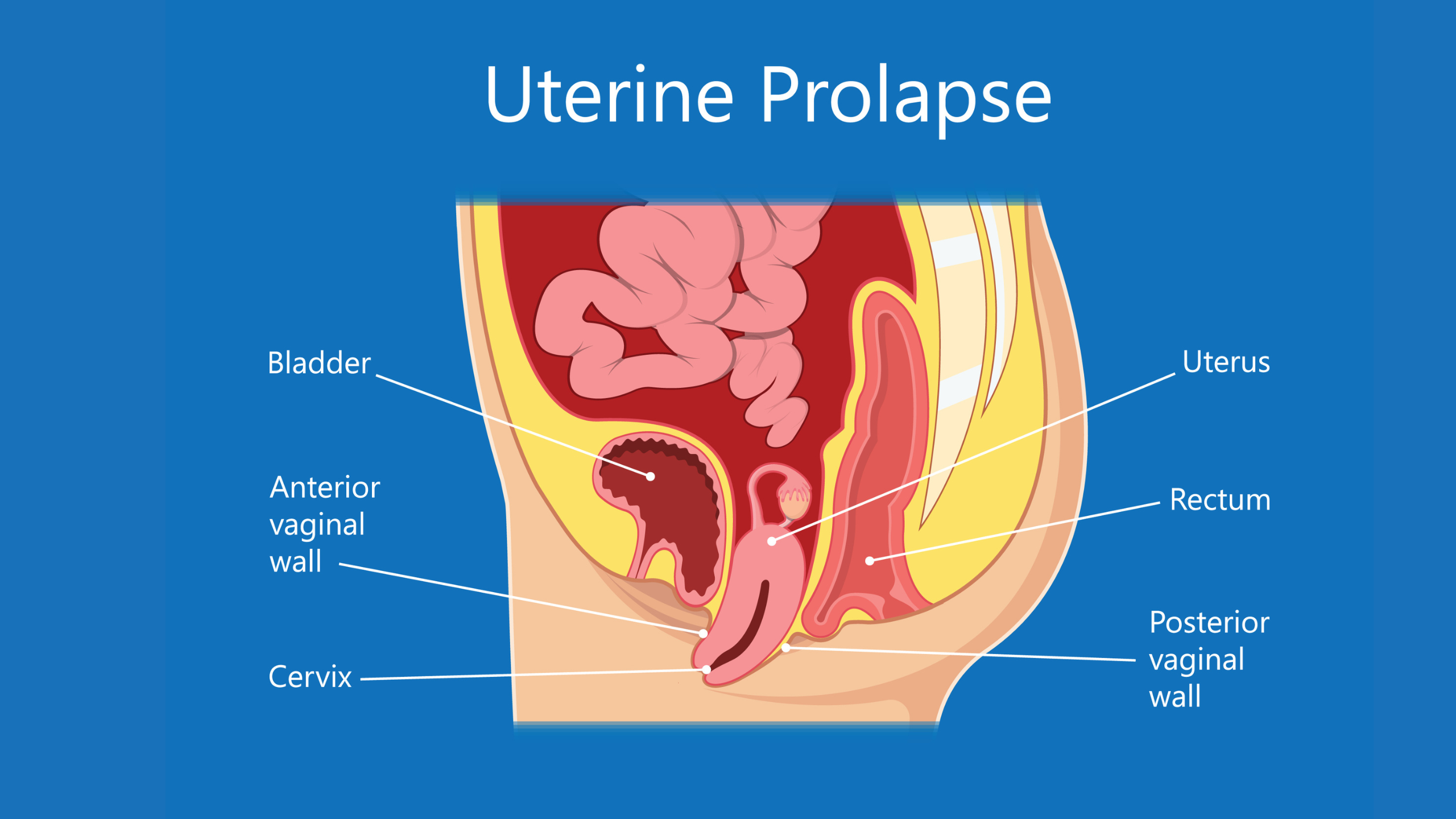 Laparoskopiki therapeia kysteokilis (2) Laparoskopiki therapeia kysteokilis 2