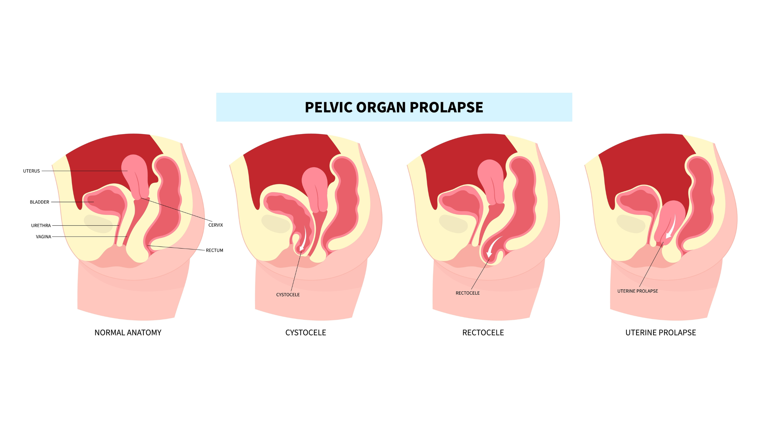 Laparoskopiki therapeia kysteokilis 3